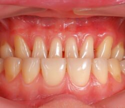 European Gum Health Day