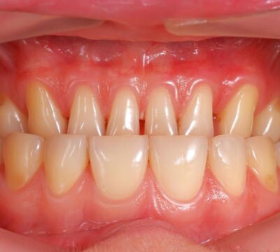 European Gum Health Day